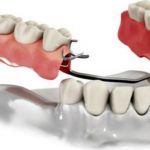 Когда требуется протезирование зубов?